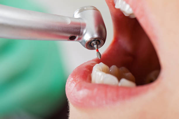 Best Knocked-Out Tooth (Avulsed Tooth) Treatment in Richmond, IL